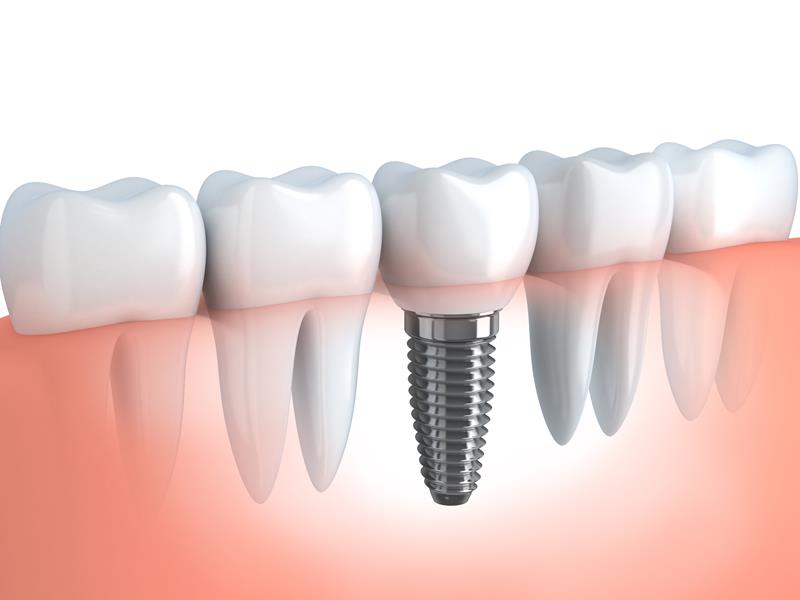 Dental Implants Bellflower, CA